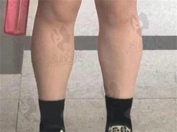 找北京联合丽格冯庆亮医生做小腿吸脂，我拥有了纤细均匀的双腿