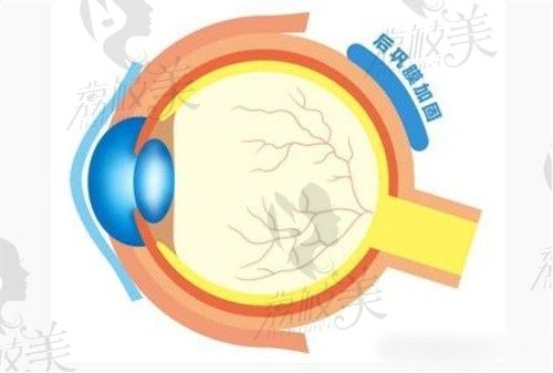 王乐今后巩膜加固术手术材料是异体巩膜很安心,是国内top级