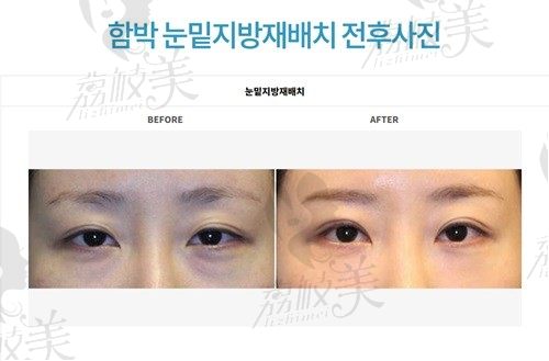 韩国大眼睛医院眼底脂肪重排术后记，重塑明眸不是梦