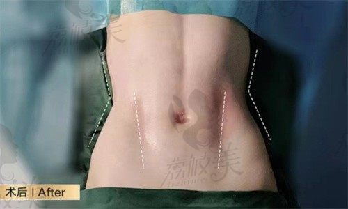 德阳金荣医学美容专科医院很正规,杨胜海做腹壁成型术是一绝