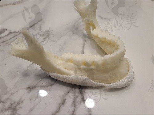 韩国欧佩拉金锡汉院长PCl补骨,3D打印定制相容性好贴合度高