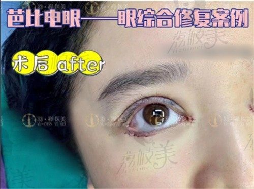 哈尔滨杨宇梓是羽禅医美的,做双眼皮修复很擅长1999元起