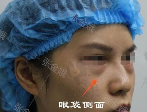 北京紫洁不开刀去眼袋可靠吗？可靠是特色项目UM无痕去眼袋价格6800元起