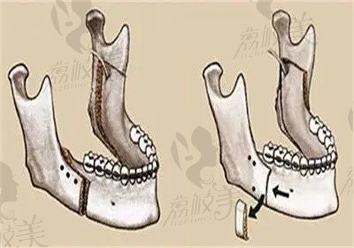 牙槽骨突出牙性和骨性区别是什么?牙列/颌骨结构等症状不同