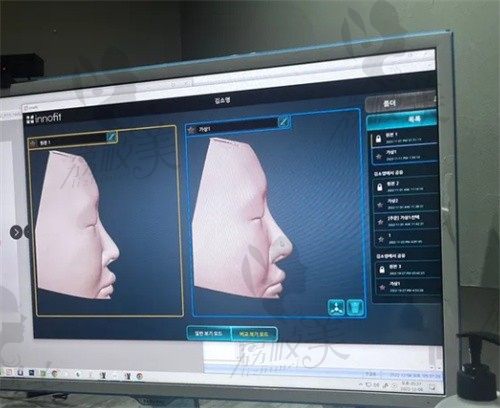 韩国GNG医院鼻修复外观+内部双重改善,鼻型稳定创伤小风格自然