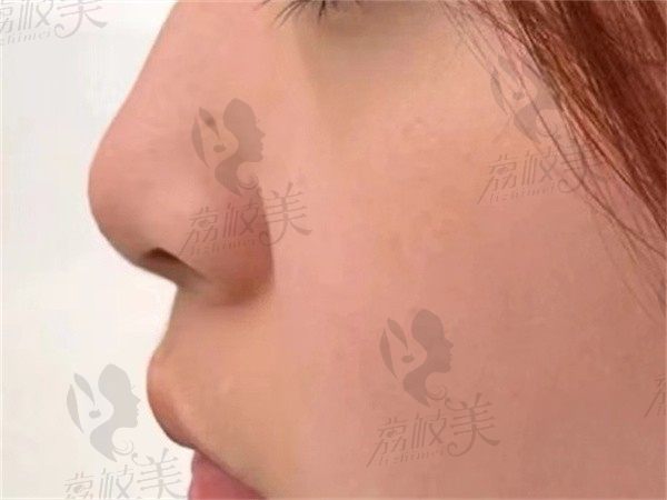 南京友谊整外金柱翰做鼻子技术真绝，给我做的鼻子立体又自然