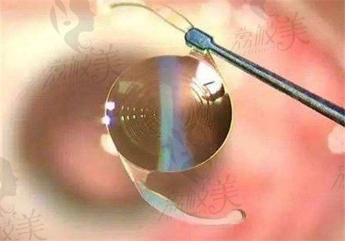 武汉眼科医生刘磊近视手术做的好，飞秒激光\晶体植入技术好可在线预约
