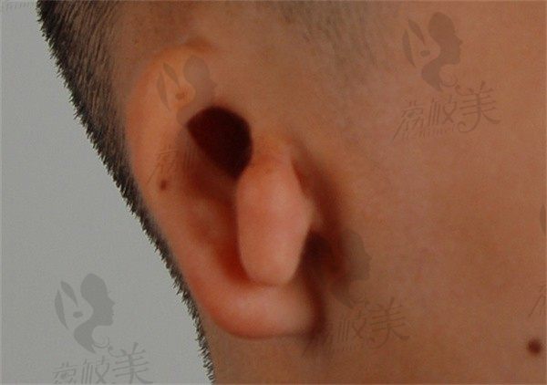 一度小耳畸形需要做手术吗？如果做耳再造需要取多少肋骨