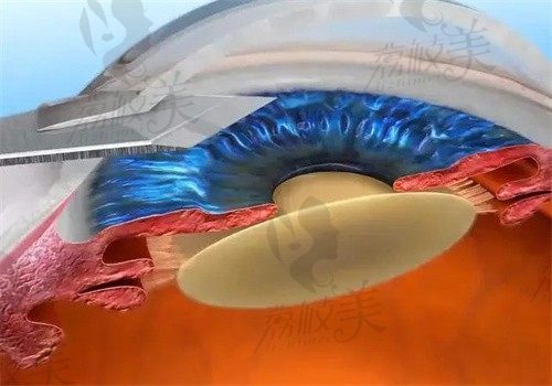 海南省眼科医院曾明兵白内障手术做的好，三焦点晶体2.3w起性价比高