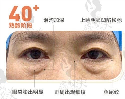 广州健丽去眼袋是真的好,不开刀去眼袋效果自然有图片可参考3w起
