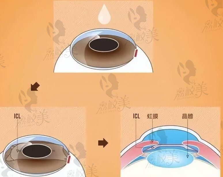 罗岩医生晶体植入多少钱？据说经验丰富怎么样才能挂的上号呢？