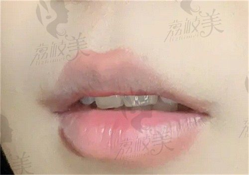 上海美莱黄惠真是九院硕士,擅长改唇形手术,长期坐诊上海美莱可预约