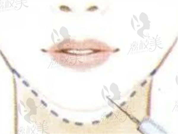杭州艺星的林千里医生怎么样，手法很赞给我注射后我的脸超饱满