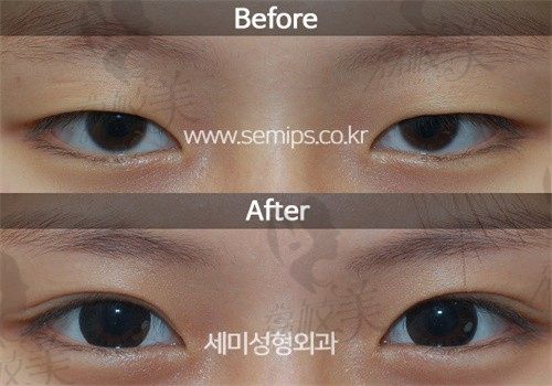 韩国世美双眼皮修复案例分享，从双眼无神到灵动有神只差一个朴相炫