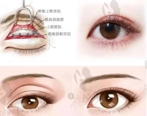 上海刘平双眼皮修复价格+医院地址整理：修复双眼皮费用3W~6W起