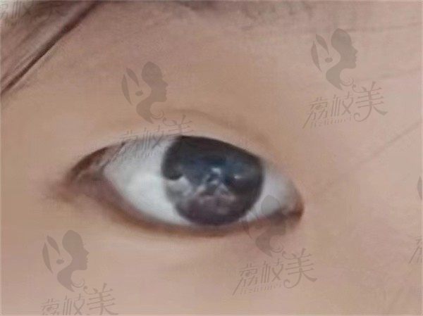 西安孙峰双眼皮手术好不好,很赞1w+让我有了妈生感十足的双眼