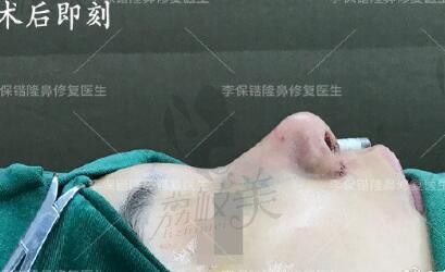 杭州李保锴鼻综合修复效果好，我选的肋软骨+膨体隆鼻自然又稳固