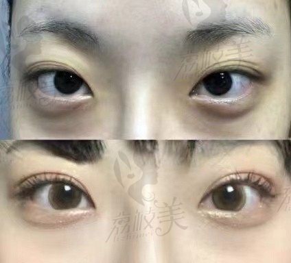 韩国DH枓翰整形外科怎么样?申枓翰做双眼皮技术好线条流畅