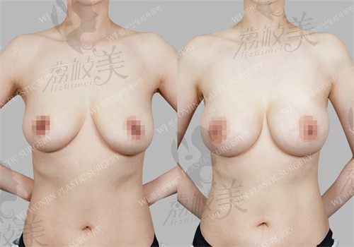 手术前