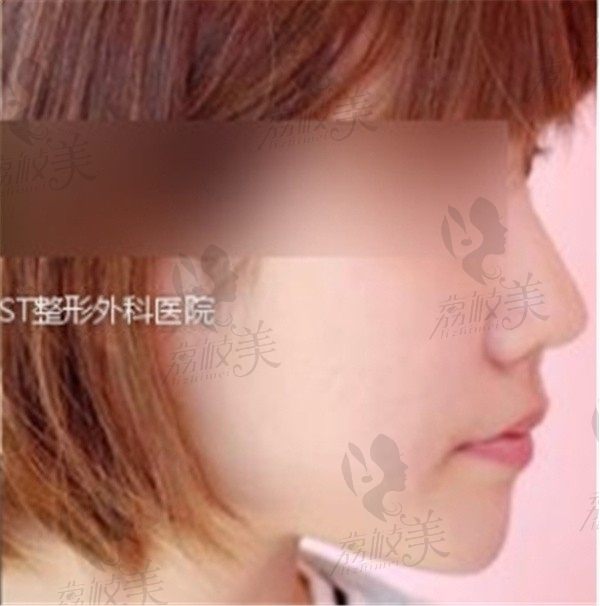 手术后