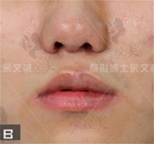 余文林修复唇鼻畸形的案例分析,看得出他做二期修复手术效果不错