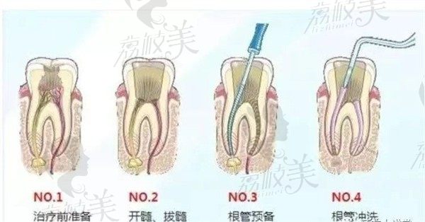 廈門做根管治療哪家醫(yī)院性價比高？麥芽、登特，優(yōu)梨技術(shù)好還不貴