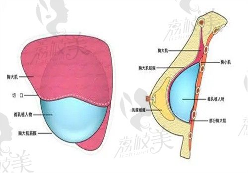 陈郇医生怎么样？擅长复杂假体隆胸及修复手术技术好案例多可预约