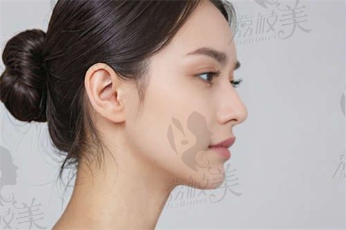 杭州谭晓燕医生如何，隆鼻很出名，尤其是异体肋软骨远期效果好