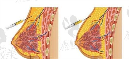 郑州王永功做胸怎么样？内窥镜隆胸技术好价格还实惠