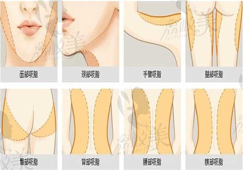 北京黄寺于波面部吸脂怎么样？看个人资料简介吸脂技术好价格8W起