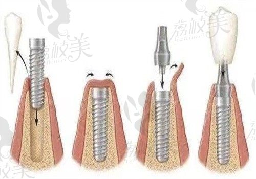 深圳哪家牙科医院镶假牙好?格伦菲尔/麦芽/正夫/同步齿科经验丰