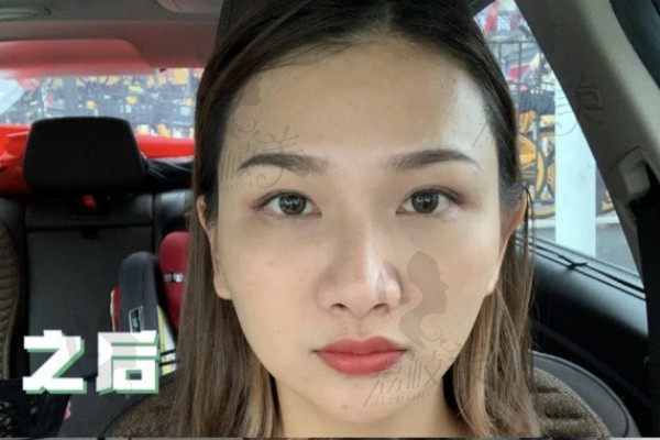 手术后