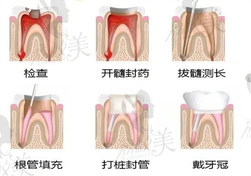 长春做根管治疗哪家医院性价比高？牙博士根管价格199起性价比高