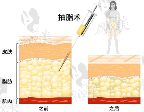 深圳八大处整形医院黄奔大腿吸脂7800起，吸出脂肪纯度高效果好