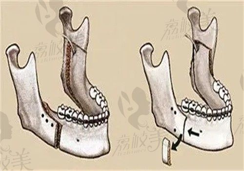 广州广大口腔医院正颌手术价格表公布，单颌/双颌详细费用+真实案例