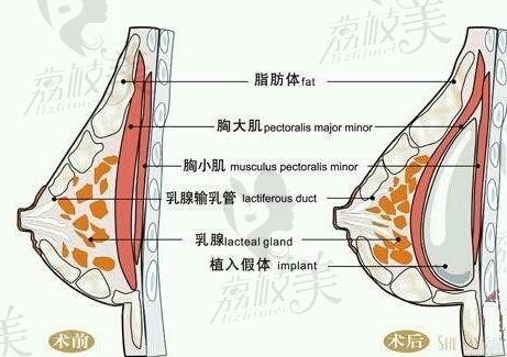 什么是nc隆胸？nc隆胸和内窥镜隆胸哪个好？价格贵么