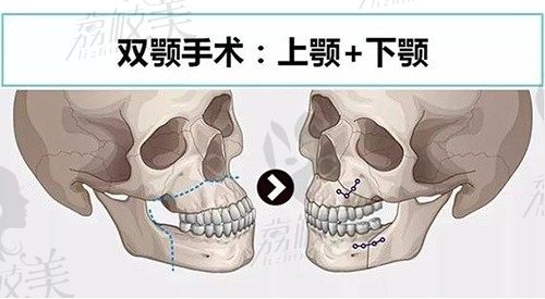 广州美恩整形周会喜做双鄂手术9.5W元起,内窥镜辅助出血少风险小