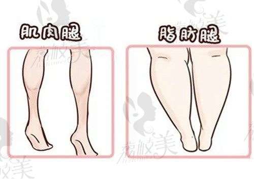 小腿抽脂好还是打瘦腿针好?脂肪医生告诉你肌肉型小腿怎么瘦？