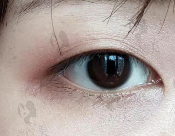 手术前