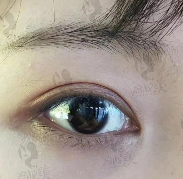 手术后