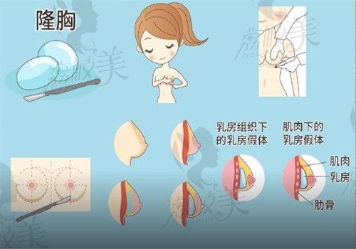 蒙喜永隆胸怎样?个人资料与经历显示蒙喜永医生成功案例多