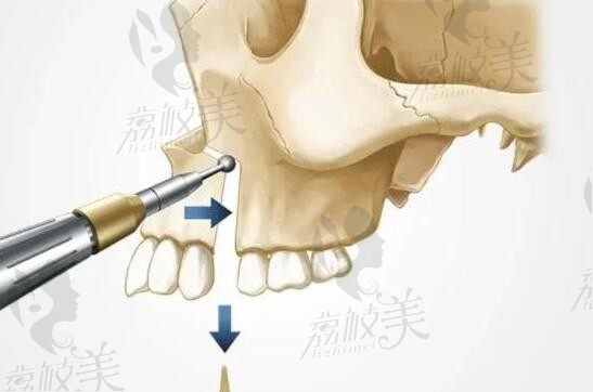 全国正颌手术前十的医生排名2024，名单上有罗恩/何锦泉/张笑天