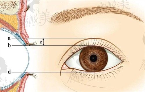 宁波美莱喻正虹割双眼皮技术好，眼综合价格7000起疤痕隐形线条自然