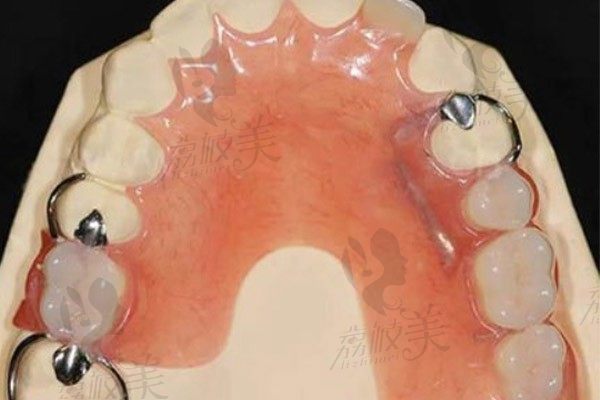 寧波桃源口腔醫(yī)院盛瑩臻做維他靈活動義齒鑲牙費用8000起,佩戴舒適