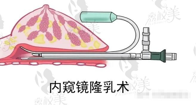 徐国建隆胸价格30000+，做傲诺拉假体IMF丰胸技术厉害创伤小