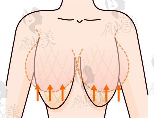 重庆当代巨乳缩小手术价格4.5万起，安可忍做缩胸+下垂矫正一步到位