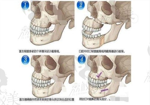 武汉亚韩赵贵庆怎么样?擅长3D下颌角和3D颧骨颧弓重塑技术