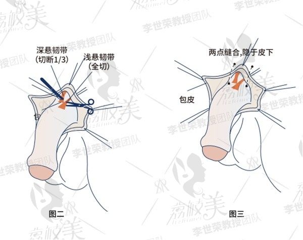 李世荣做延长术效果确实好，拿手的是隐痕阴茎延长术点击获取价格