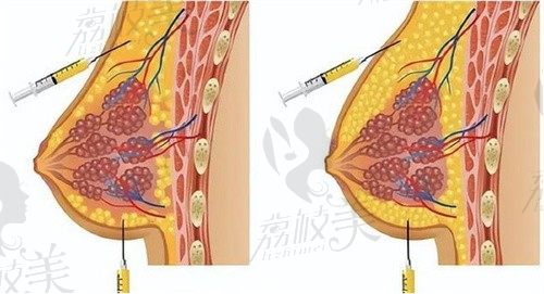 贺天遥医生丰胸怎么样?做脂肪填充丰胸技术好案例多值得预约