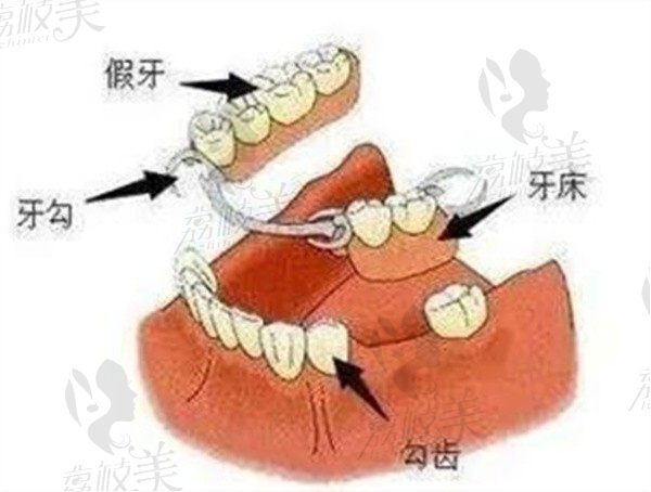 无挂钩假牙和种植牙的区别在哪？从固定方式及舒适度等方面来解析